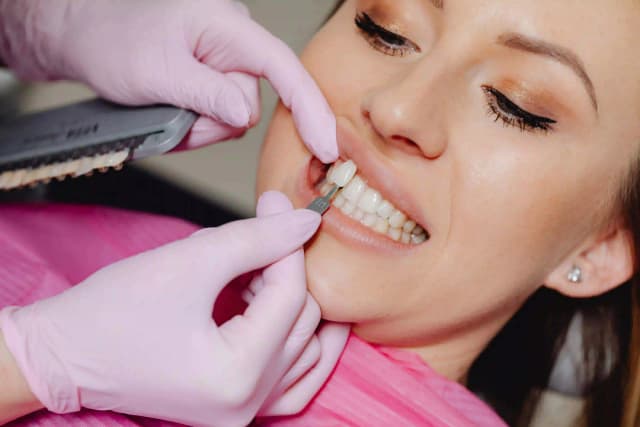 ¿Cuánto duran las carillas dentales?