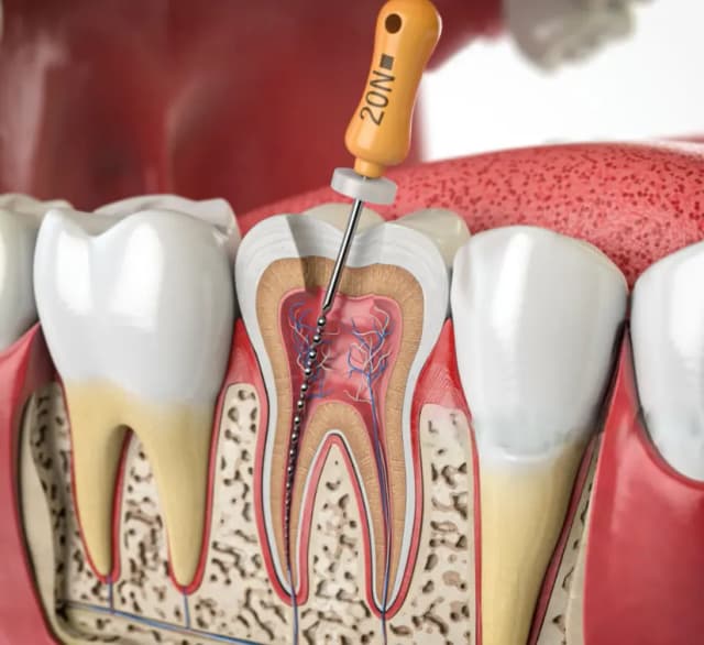 Endodoncia